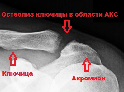 Остеолиз ключицы в области АКС