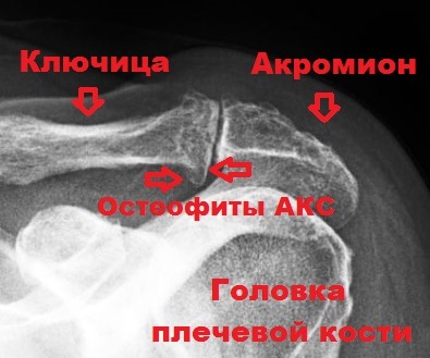 головка плечевой кости остеофиты АКС