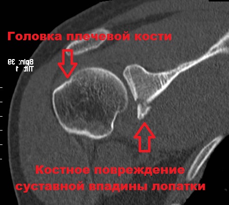 Фиксация суставной губы Схема операции