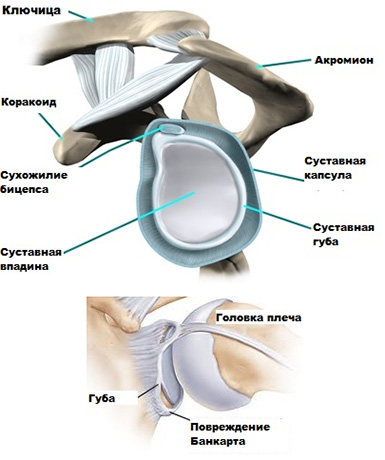 Лечение повреждения Банкарта Повреждение Банкарта