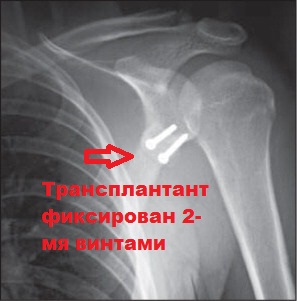 Трансплантант фиксирован 2-мя винтами Рентгенограмма Латерже