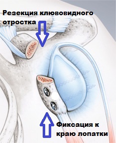 Фиксация к краю лопатки Резекция клювовидного отростка