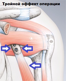 Тройной эффект операции Повреждение Банкарта
