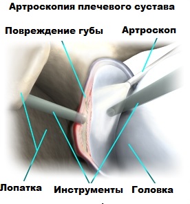 Малоинвазивное лечение Артроскопия плечевого сустава