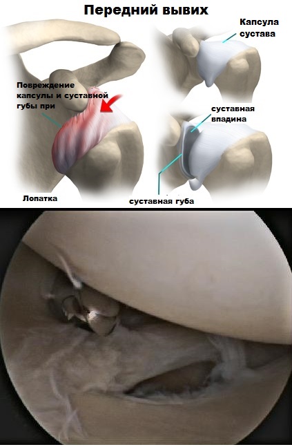 Повреждение капсулы и суставной губы Передний вывих плеча