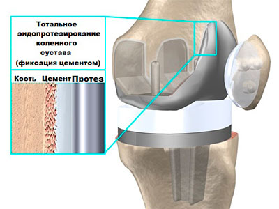 фиксация протеза цементом