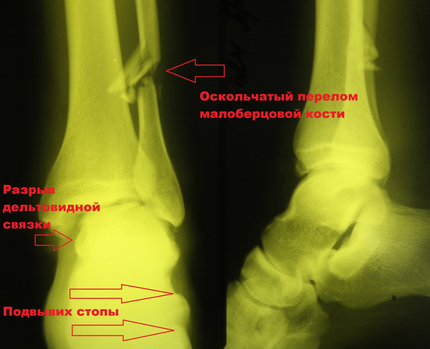 Как определить трещину в кости. Осколочный перелом малой берцовой кости. Оскольчатый перелом малой берцовой кости. Пронационный перелом лодыжки. Перелом лодыжки и малоберцовой кости со смещением.