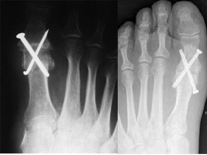 Röntgenbild der Arthrodese