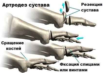 Arthrodese