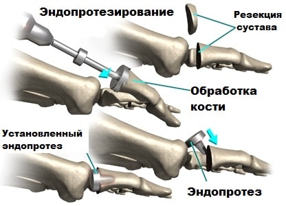 Endoprothese