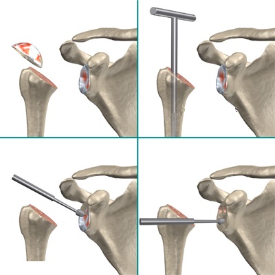 анатомический протез