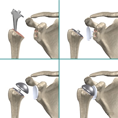 анатомический протез