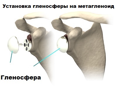 установка гленосферы на метагленоид