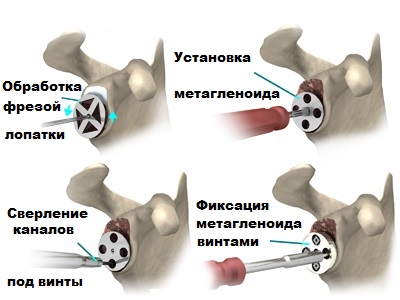 установка метагленоида