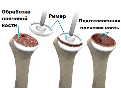 подготовка костно-мозгового канала
