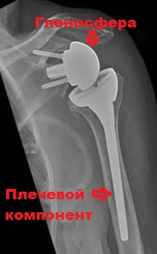 рентген реверсивный протез