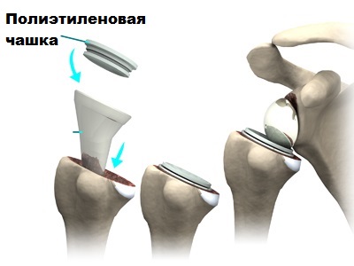 реверсивный протез в сборе