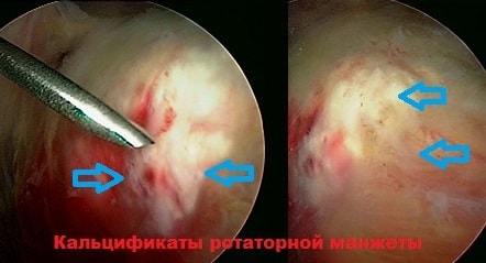Артроскопия кальцификат
