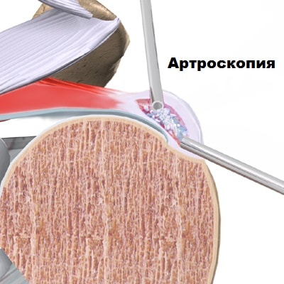 Кальцифицирующий тендинит артроскопия