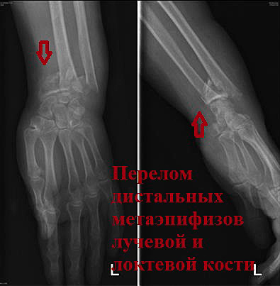 Перелом дистальных метаэпизов лучевой и локтевой кости