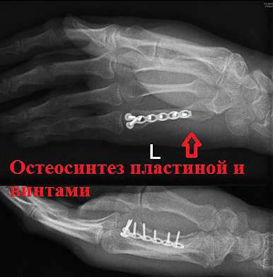 неудовлетворительное положение отломков после репозиции