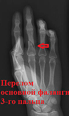 перелом фаланги пальца