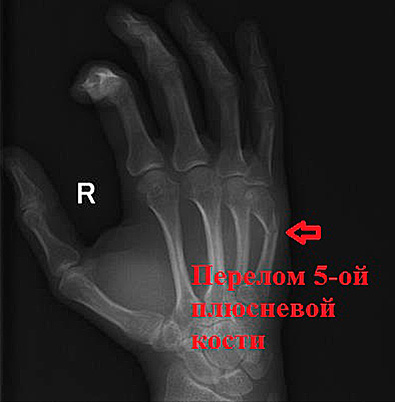 перелом пятой плюсневой кости