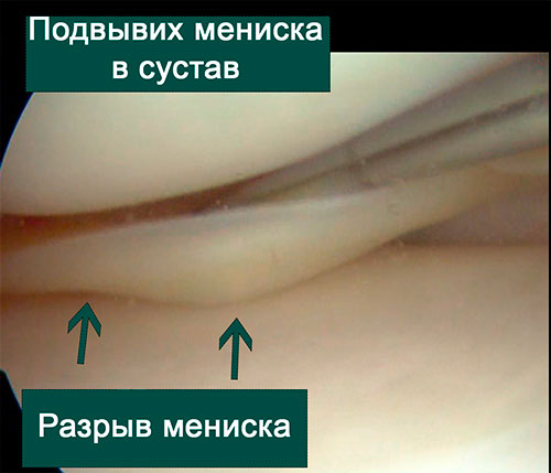 разрыв мениска