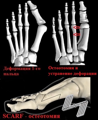 Skapula-Osteotomie