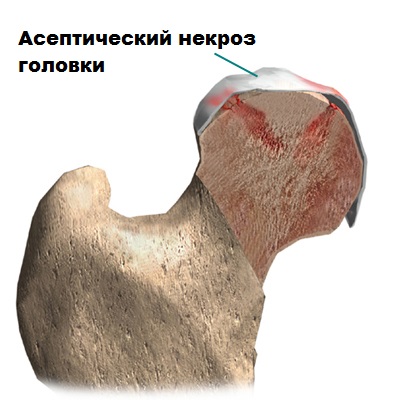Асептический некроз