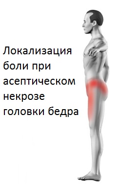 боль при асептическом некрозе головки бедра