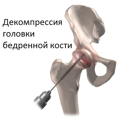 Декомпрессия головки бедренной кости
