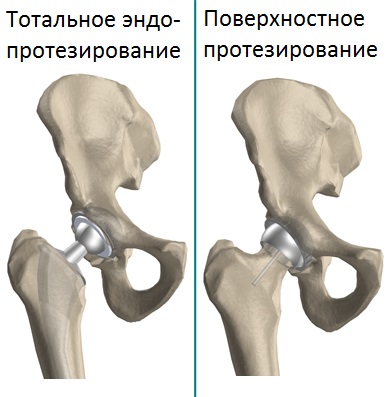 Эндопротезирование при асептическом некрозе