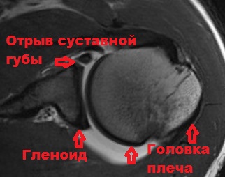 Плечевая губа суставная разрыв