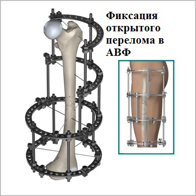 фиксация открытого перелома в АВФ