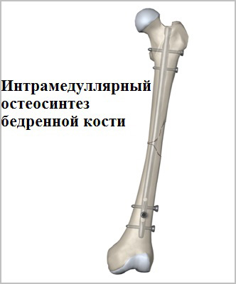 интрамедуллярный остеосинтез бедренной кости
