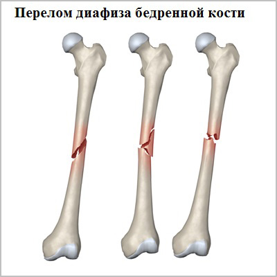 перелом диафиза бедренной кости