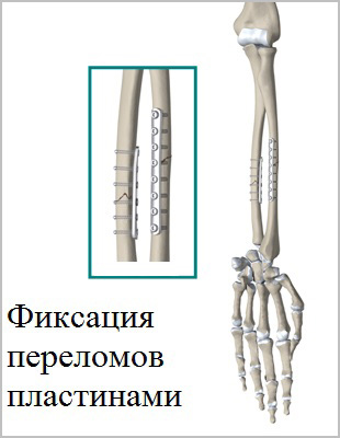 фиксация переломов пластинами