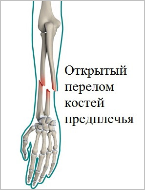 открытый перелом костей предплечья