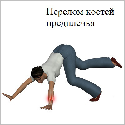 перелом костей предплечья