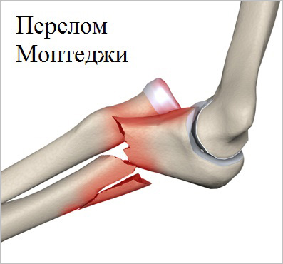 перелом Монтеджи