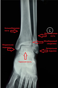 Голеностопный сустав норма. Сесамовидная кость голеностопного сустава. Большеберцовая кость и голеностопный сустав. Анатомия малоберцовой кости рентген. Голеностоп рентген норма и перелом.