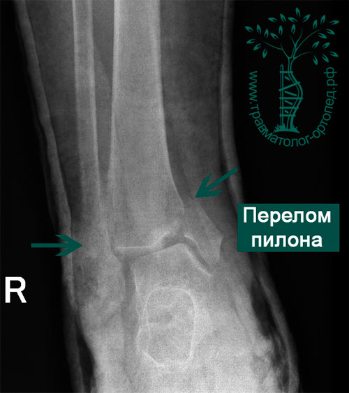 перелом пилона