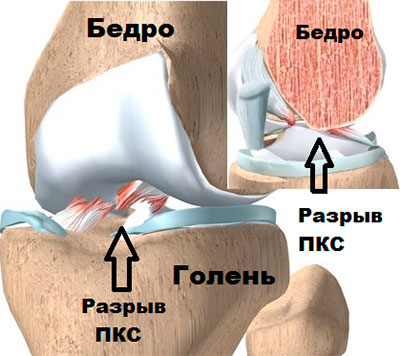 Разрыв ПКС