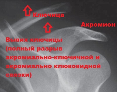Рентген ключицы