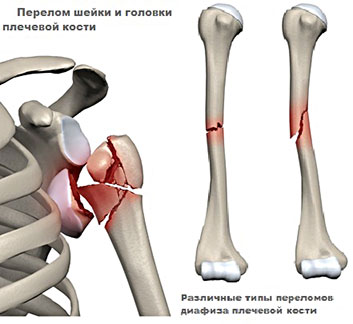 Плечевая кость человека Перелом шейки и головки