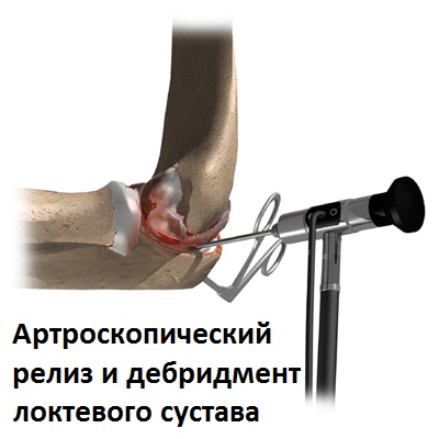 Артроскопия тугоподвижность локтевого сустава
