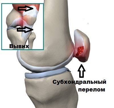 Субхондральный перелом 2