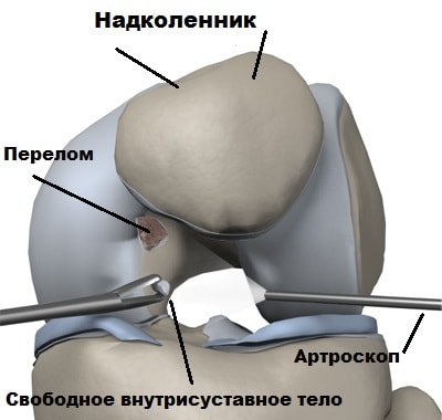Субхондральный перелом