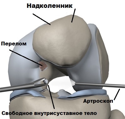 Перелом надколенника операции. Артроскопия надколенника. Медиальный вывих надколенника. Вывих надколенника артроскопия. Надколенника перелом латеральный.